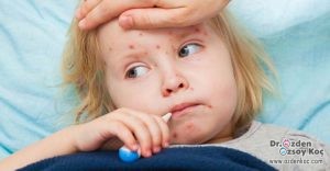 Çocuklarda Kızamık Hastalığı - Belirtileri - Tedavisi